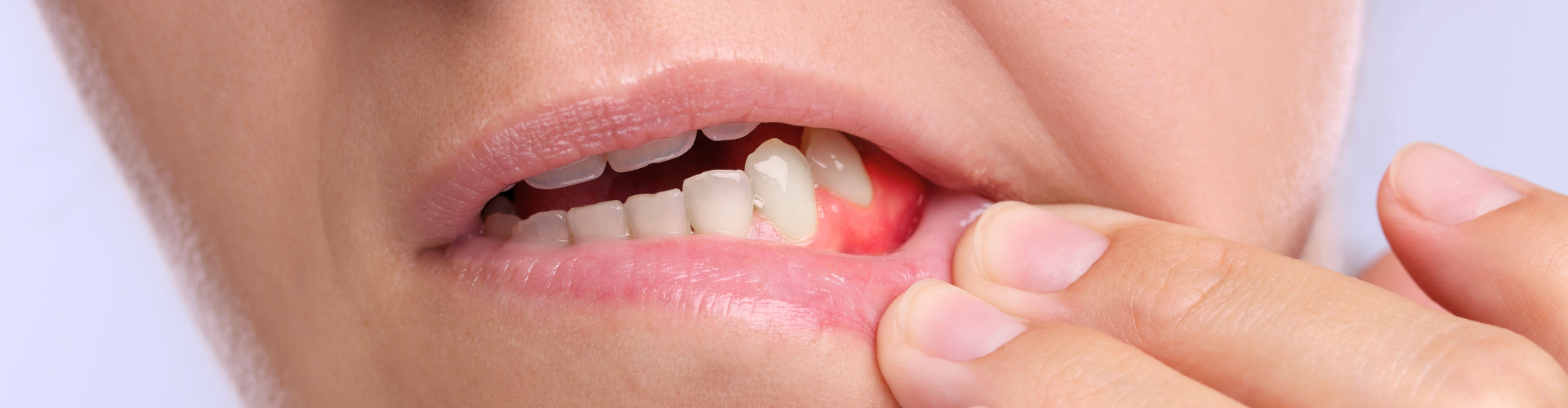 Woman pulling down lower lip to reveal inflamed gums.